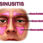 feb-sinusitis